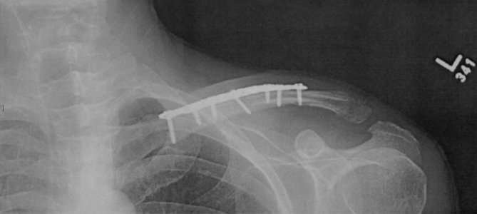 Clavicle plate.jpg